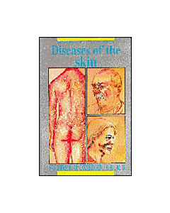 Diseases of The Skin With Illustrations
